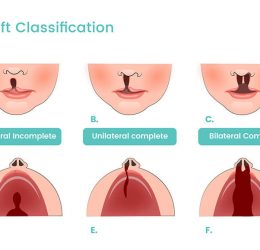 Pengertian, Diagnosis, Jenis Bibir Sumbing dan Sumbing Langit-Langit