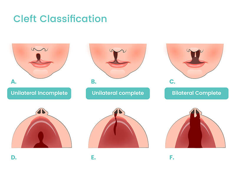 Pengertian, Diagnosis, Jenis Bibir Sumbing dan Sumbing Langit-Langit