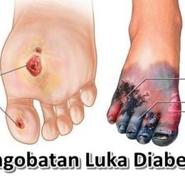 Pengobatan Luka Diabetes di Indramayu
