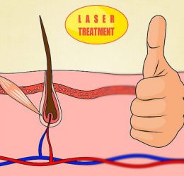 Terapi Laser di Indramayu
