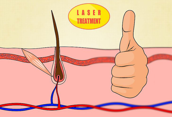 Terapi Laser di Indramayu