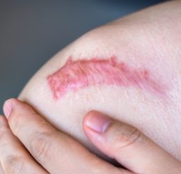 Operasi Keloid di Indramayu