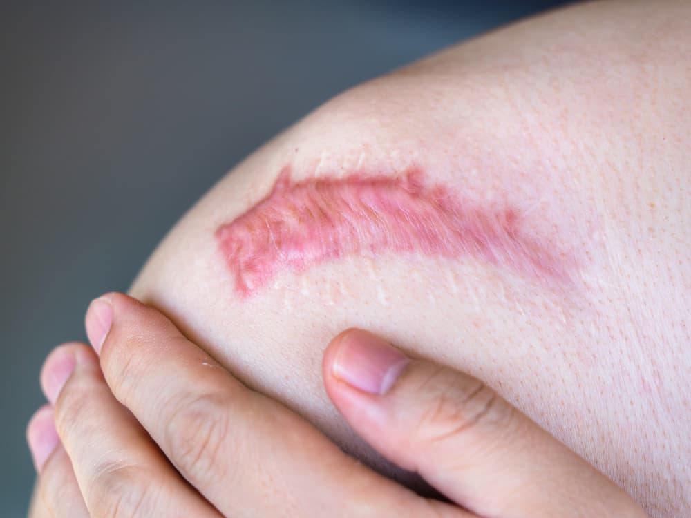 Operasi Keloid di Indramayu